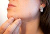 7 Domestic Ways To Get Rid Of Pimples