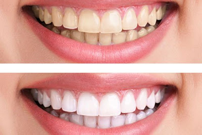 Hàm răng luôn trắng đều phải làm gì?