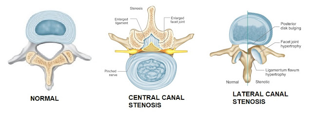 LUMBAR CANAL STENOSIS