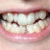  Niềng răng không mắc cài có những loại nào?