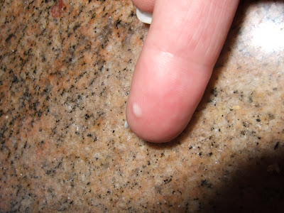 beginning of genital warts. venereal and Genital Warts