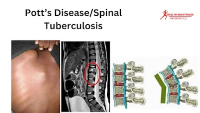 Pott’s Disease/spinal tuberculosis