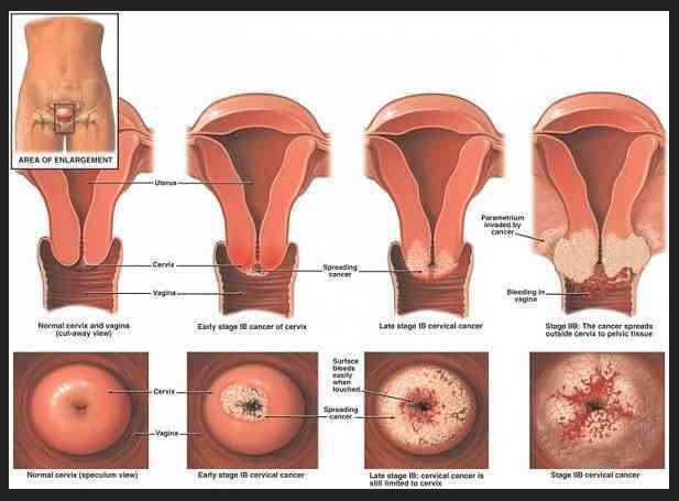 Tanda-Tanda Cara Mengesan Kanser Pangkal Rahim Kaum Wanita Wajib Ambil Tahu