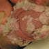 Penyakit Kutil Kelamin jengger ayam bisa menular thumbnail