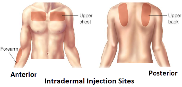 Site of Intradermal Injection