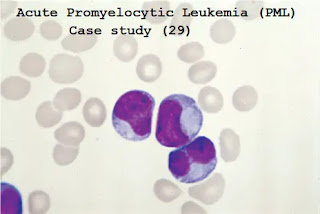 Case study (29) – Acute Promyelocytic Leukemia (PML)