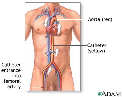 Persistent chest pain (angina)