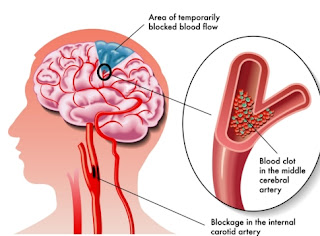 kerusakan otak karena penyakit atau pembuluh darah yang rusak