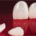 Cách khắc phục tình trạng bọc răng sứ bị hôi hiệu quả