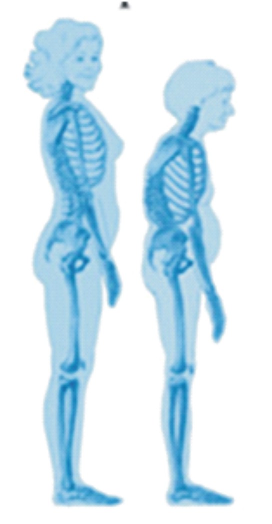 gambar penyakit tulang osteoporosis
