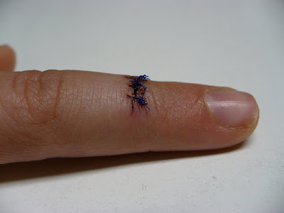 stitched-up finger