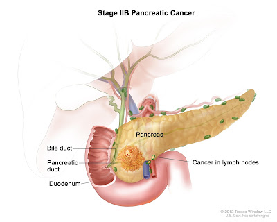 http://gastrosurgeononline.com/pancreatic-cancer/