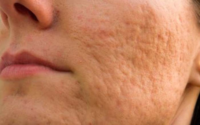 What Causes Acne Scars?