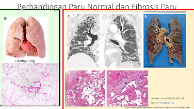 Perbandingan Paru