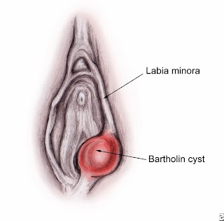 Gejala Kista Bartholin dan Pengobatan Kelenjar Bartholin