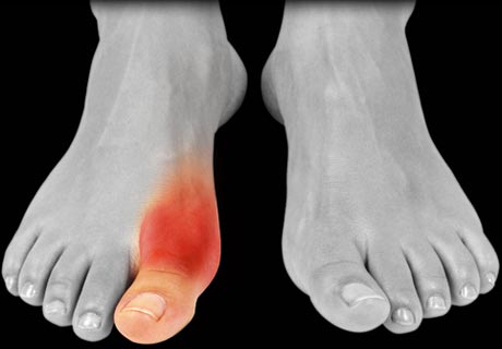 Homeopathy Lembut, Selamat dan Boleh Dipercayai: Gout 