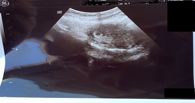 5 haftalık gebelik ultrason görüntüleri