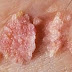 Obat Alami Kutil Kelamin Pada Wanita thumbnail