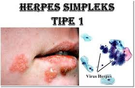 Cara Paling Ampuh Untuk Mengobati Herpes