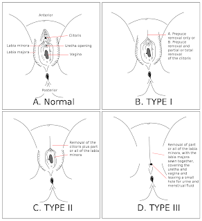 WHO'ya göre kadın genital kesiminin türleri ve normal anatomiden farkları