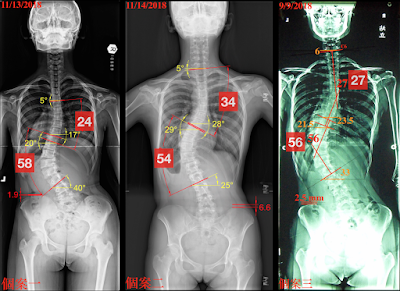 脊椎側彎, 脊椎側彎 矯正, 脊椎側彎治療