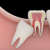 Dấu hiệu nhận biết răng khôn mọc lệch