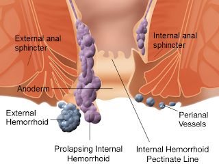 internal hemorrhoid, internal hemorrhoids, internal hemorrhoid symptoms, internal hemorrhoids symptoms, symptoms of internal hemorrhoids, internal hemorrhoids treatment, 