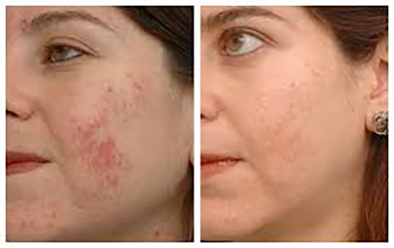 Different Methods for Treating Acne Scars