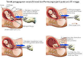 Buih-buih laut dalam: Abortion baby