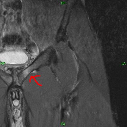 Hip+stress+fracture+mri