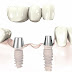 Những lý do làm trụ implant bị đào thải