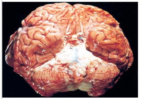 otak meningitis