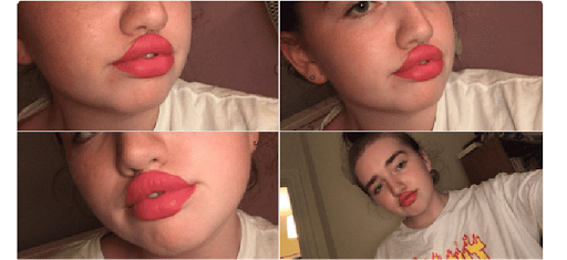 Glued lips, unhealthy beauty standards