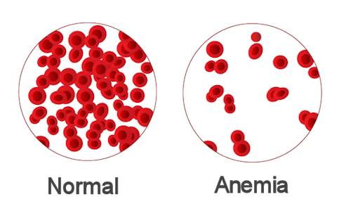 Penyakit Anemia Cara Mengatasi Anemia atau Kurang Darah