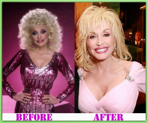 plasticsurgeryfeet: Dolly Parton Plastic Surgery: It Was ...