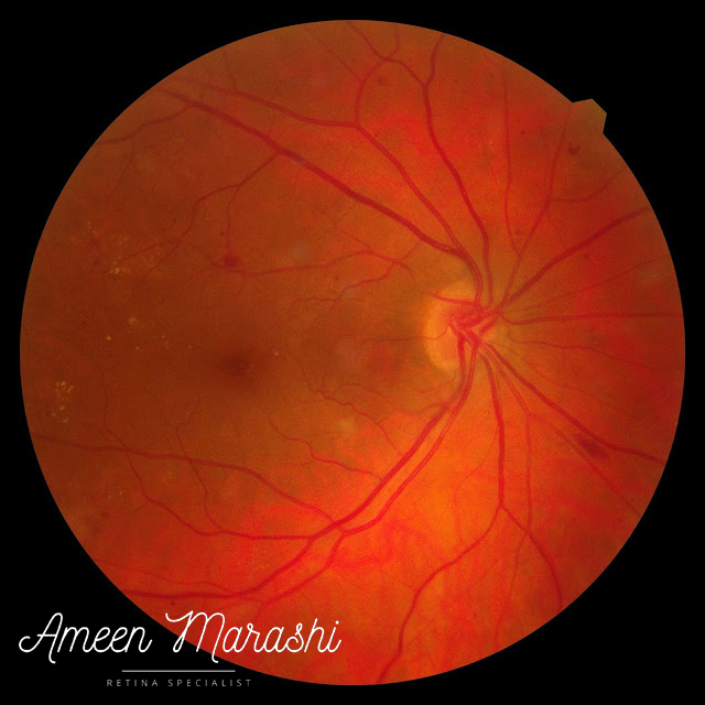 Fundus image of subtle NVD