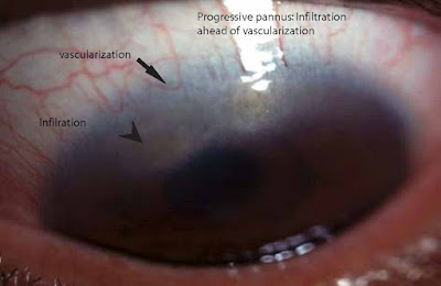 herbert's pits pitted cornea follicles trachoma signs