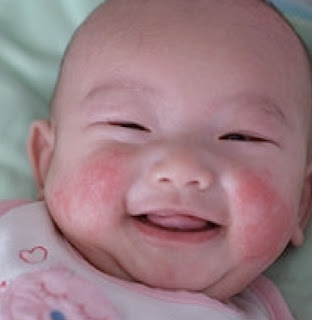 Baby Eczema Pictures