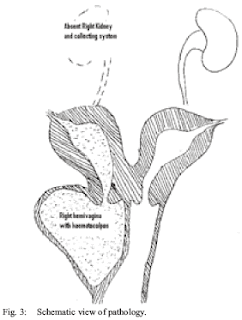   uterus bicornis, bicornuate unicollis uterus, bicornuate bicollis uterus, bicornuate uterus pregnancy, bicornuate uterus treatment, bicornuate uterus causes, bicornuate uterus symptoms, bicornuate uterus pregnancy pictures, partial bicornuate uterus