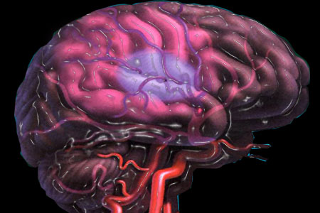 A stroke, or cerebrovascular