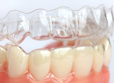 Quy trình niềng răng không mắc cài 3D Clear