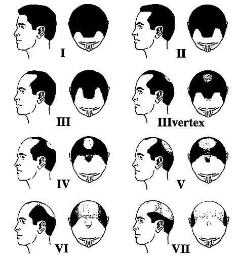 Scala di Hamilton–Norwood - Classificazione dell'alopecia maschile