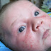 The Solution for Baby Acne  - All About Acne