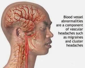 Migraine Head Ache Homeopathy Treatment Chennai Tamil Nadu Migraine Head Ache Homeopathy Treatment Chennai Tamil Nadu