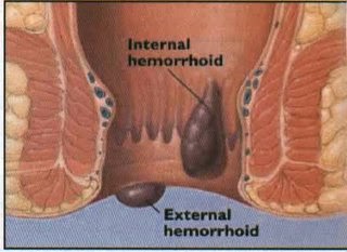 Wasir atau Hemoroid