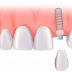 Thực hiện hàm phủ trên Implant