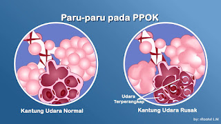 Penyakit Paru Paru PPOK