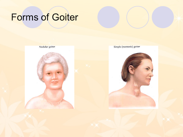 Forms of Goiter
