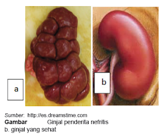 nefritis