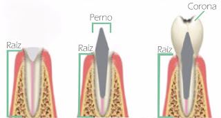 perno corona funda calza dental